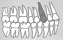 Zahn-Körper-Beziehungen Zahn 13
