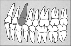 Zahn-Körper-Beziehungen Zahn 23
