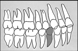 Zahn-Körper-Beziehungen Zahn 44